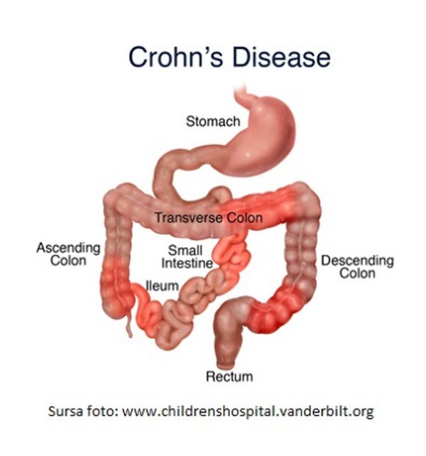 afectarea articulară în boala Crohn)